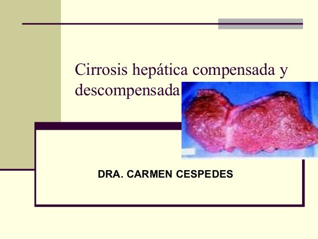 cirrosis descompensada